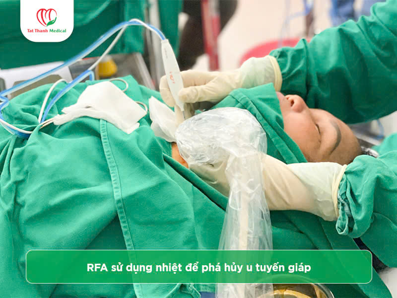 Máy đốt sóng cao tần u tuyến giáp: Lợi ích và địa chỉ mua hàng chính hãng