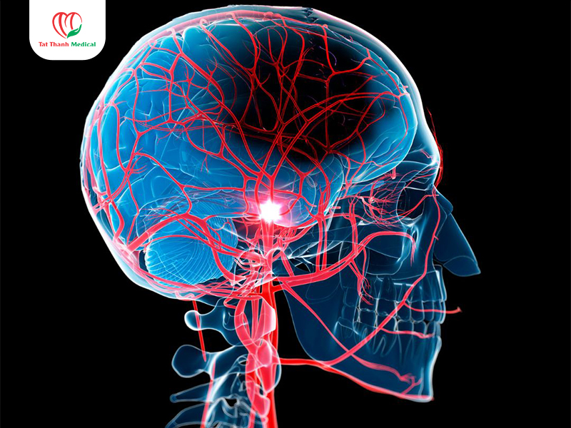 Rối loạn tuần hoàn não: Thiết bị nào giúp đánh giá chức năng hiệu quả?