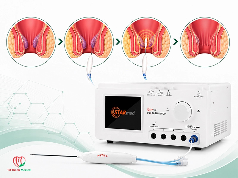 VIVA RF System (VRS01): Giải pháp điều trị trĩ bằng RFA cho phòng khám vừa và nhỏ